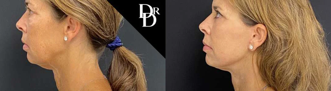Facelift Before And After Photos By Dr. Demetri Arnaoutakis In Tampa, Fl
