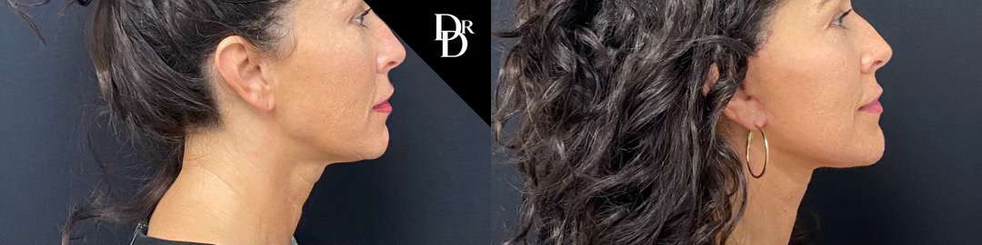 Facelift Before And After Photos By Dr. Demetri Arnaoutakis In Tampa, Fl