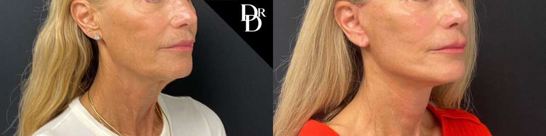 Facelift Before And After Photos By Dr. Demetri Arnaoutakis In Tampa, Fl