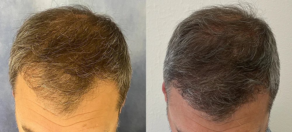 Hair Transplant Before And After Photos By Dr Demetri Arnaoutakis In Tampa Fl