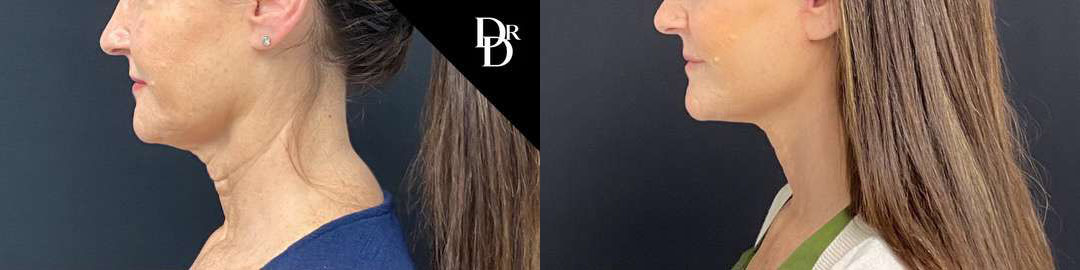 Facelift Before And After Photos By Dr. Demetri Arnaoutakis In Tampa, Fl