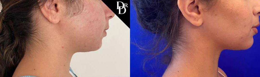Buccal Fat Pad Removal before and after photos by Dr. Demetri Arnaoutakis in Tampa, FL