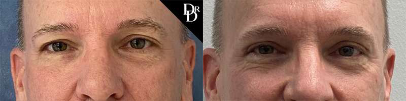 Eyelid Surgery before and after photos by Dr. Demetri Arnaoutakis in Tampa, FL