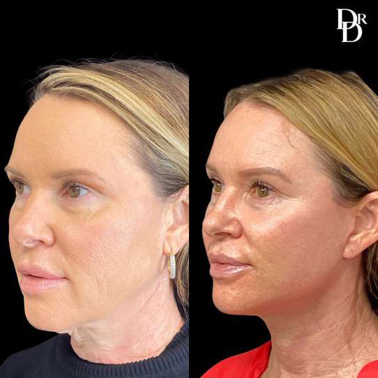 Facelift Before And After Photos By Dr. Demetri Arnaoutakis In Tampa, Fl