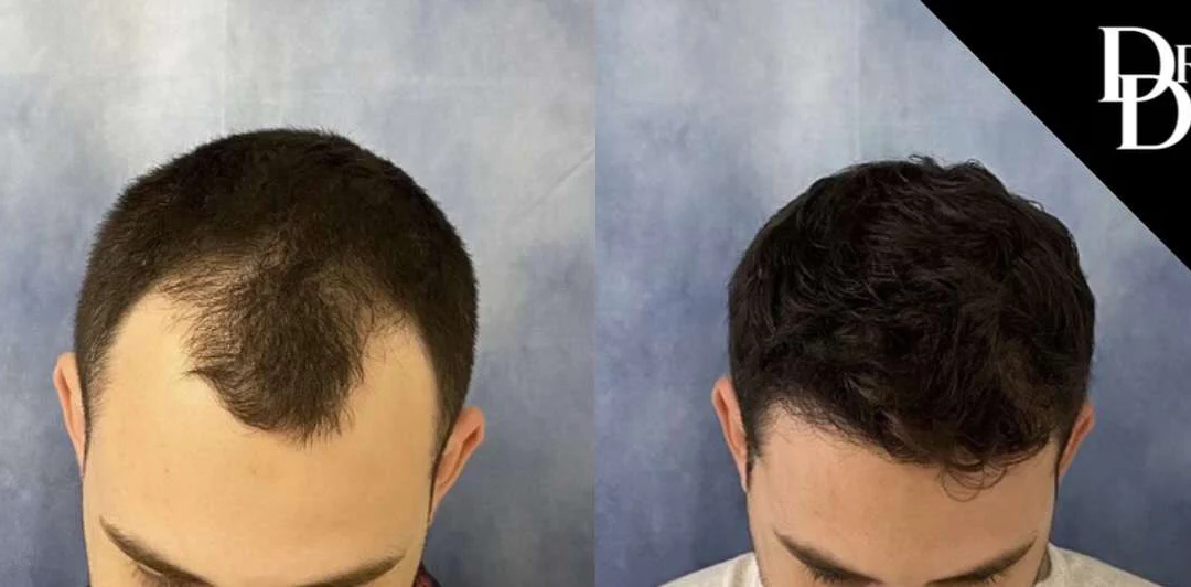 Hair Transplant Before And After Photos By Dr. Demetri Arnaoutakis In Tampa, Fl