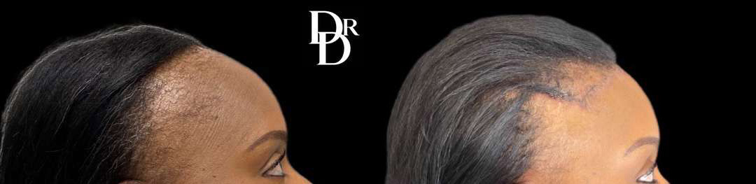 Hairline Lowering Surgery Before And After Photos By Dr. Demetri Arnaoutakis In Tampa, Fl
