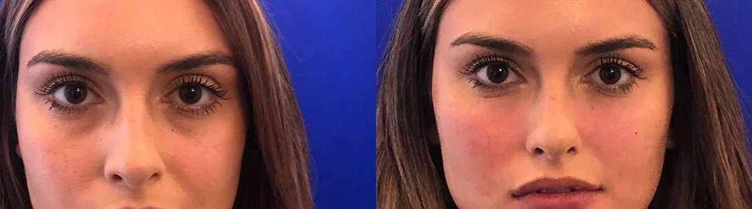 Injectable/Dermal Fillers Before And After Photos By Dr. Demetri Arnaoutakis In Tampa, Fl