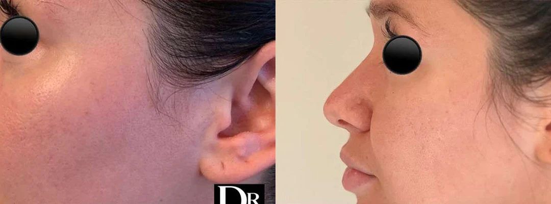 Liquid Rhinoplasty before and after photos by Dr. Demetri Arnaoutakis in Tampa, FL