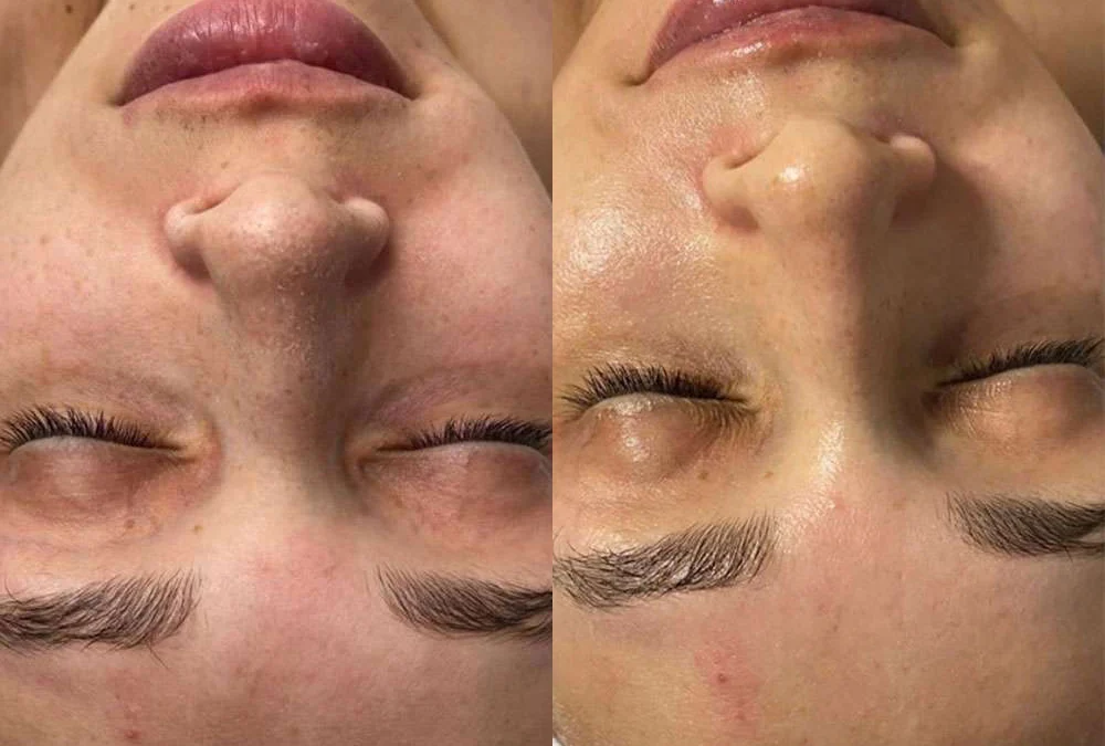 Microneedling Before And After Photos By Dr. Demetri Arnaoutakis In Tampa, Fl