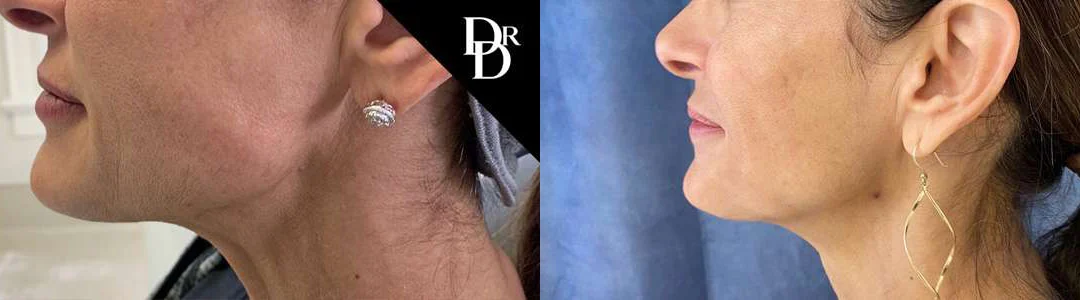 Morpheus8 Before And After Photos By Dr. Demetri Arnaoutakis In Tampa, Fl
