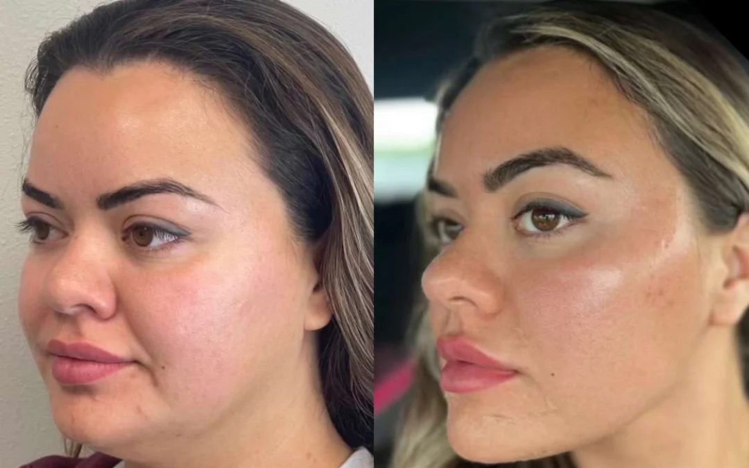 Neck Lift Before And After Photos By Dr. Demetri Arnaoutakis In Tampa, Fl