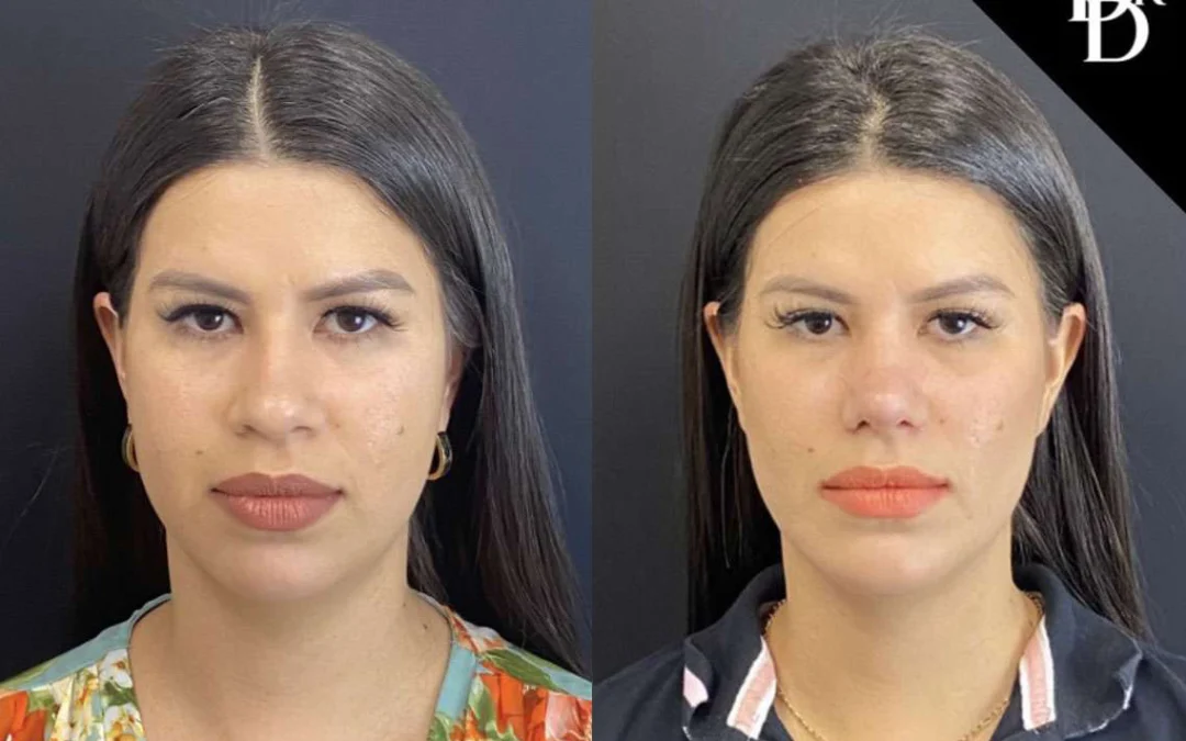 Rhinoplasty before and after photos by Dr. Demetri Arnaoutakis in Tampa, FL