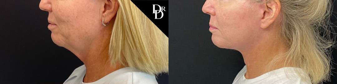 Facelift Before And After Photos By Dr. Demetri Arnaoutakis In Tampa, Fl