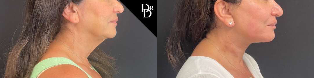 Facelift Before And After Photos By Dr. Demetri Arnaoutakis In Tampa, Fl