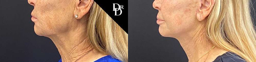 Facelift Before And After Photos By Dr. Demetri Arnaoutakis In Tampa, Fl