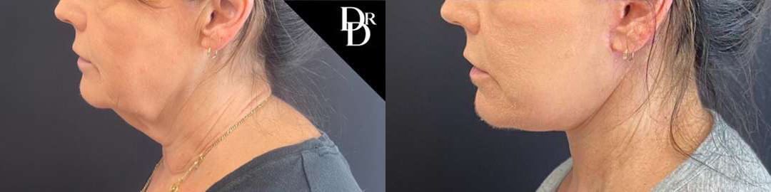 Facelift Before And After Photos By Dr. Demetri Arnaoutakis In Tampa, Fl