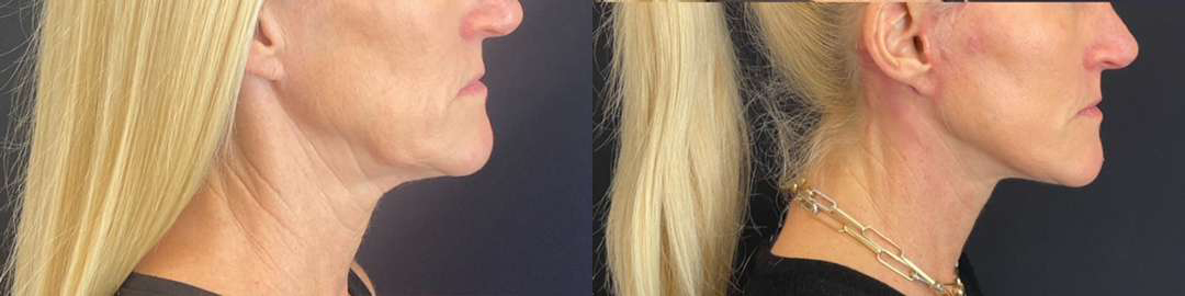 Facelift Before And After Photos By Dr. Demetri Arnaoutakis In Tampa, Fl