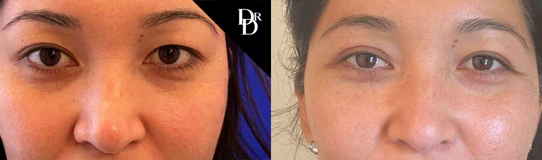 Eyelid Surgery before and after photos by Dr. Demetri Arnaoutakis in Tampa, FL
