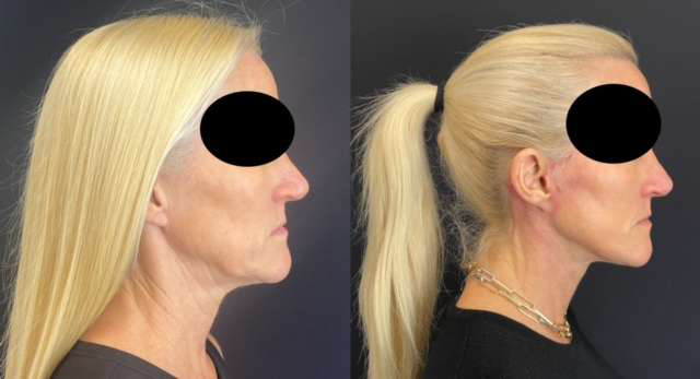Facelift Before And After Photos By Dr. Demetri Arnaoutakis In Tampa, Fl
