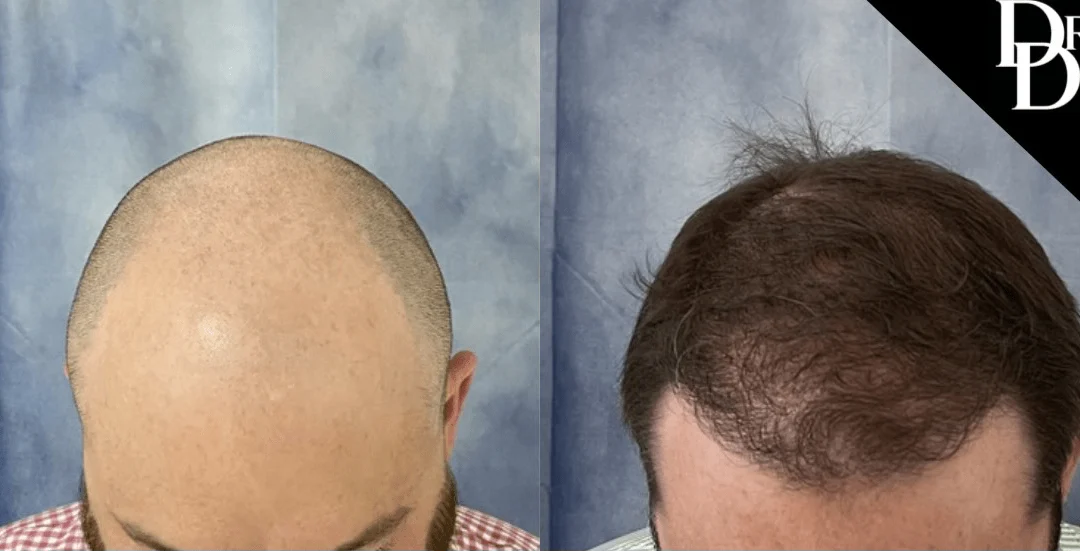 Hair Transplant Before And After Photos By Dr. Demetri Arnaoutakis In Tampa, Fl
