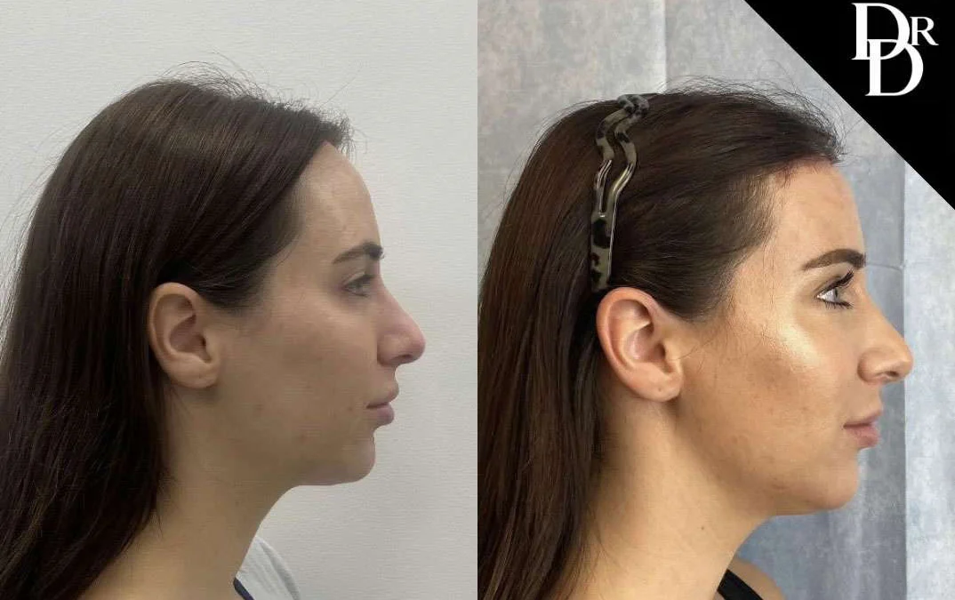 Hairline Lowering Surgery Before And After Photos By Dr. Demetri Arnaoutakis In Tampa, Fl