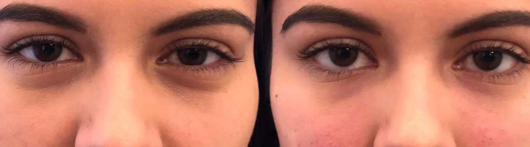 Injectable/Dermal Fillers Before And After Photos By Dr. Demetri Arnaoutakis In Tampa, Fl