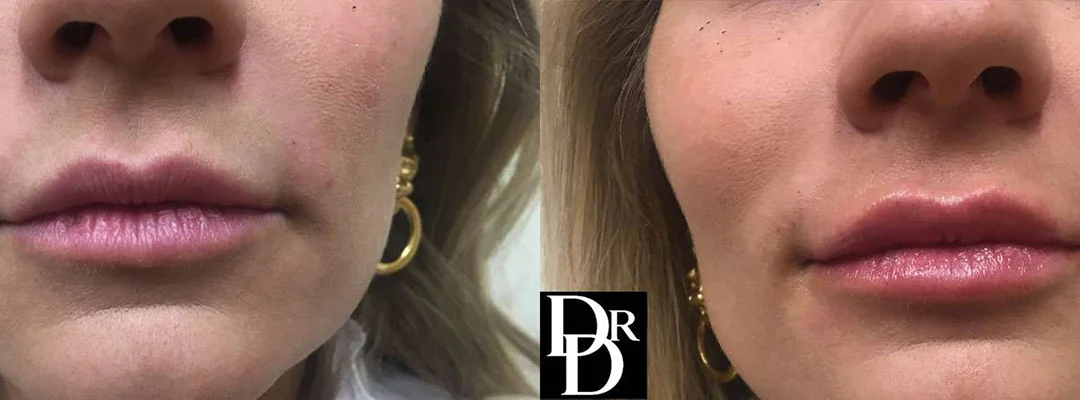 Injectable/Dermal Fillers Before And After Photos By Dr. Demetri Arnaoutakis In Tampa, Fl