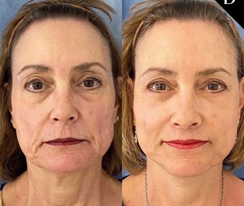 Lip Lift before and after photos by Dr. Demetri Arnaoutakis in Tampa, FL