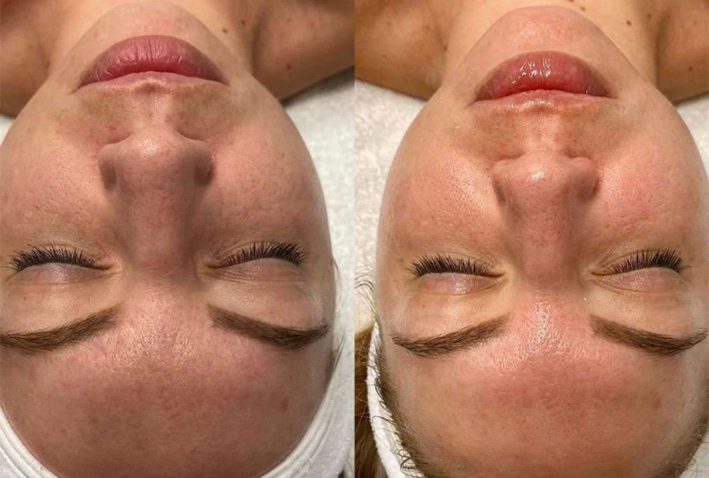 Microneedling Before And After Photos By Dr. Demetri Arnaoutakis In Tampa, Fl
