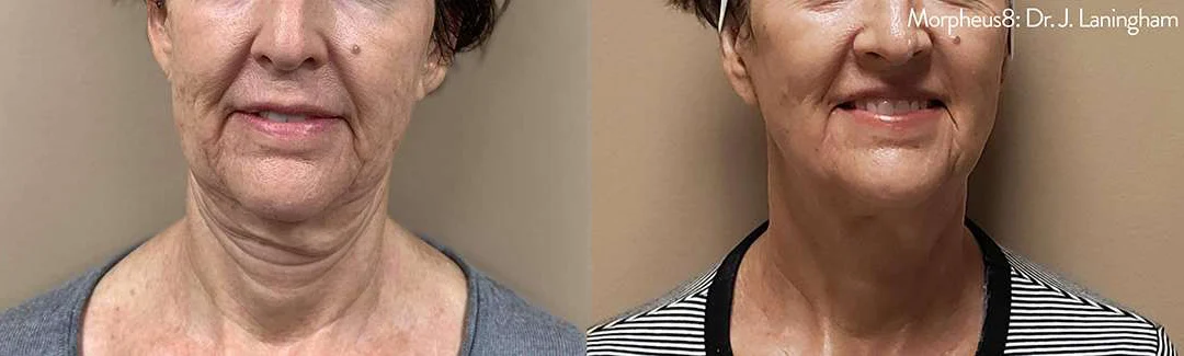 Morpheus8 Before And After Photos By Dr. Demetri Arnaoutakis In Tampa, Fl