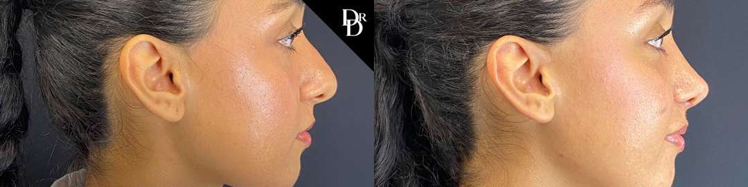 Rhinoplasty before and after photos by Dr. Demetri Arnaoutakis in Tampa, FL