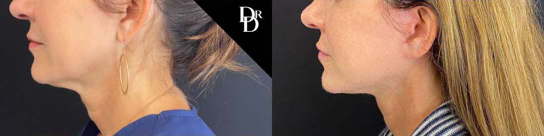 Facelift Before And After Photos By Dr. Demetri Arnaoutakis In Tampa, Fl