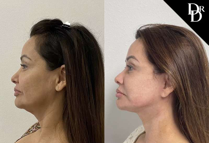 Facelift Before And After Photos By Dr. Demetri Arnaoutakis In Tampa, Fl