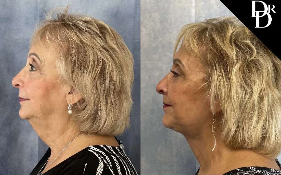 Facelift Before And After Photos By Dr. Demetri Arnaoutakis In Tampa, Fl