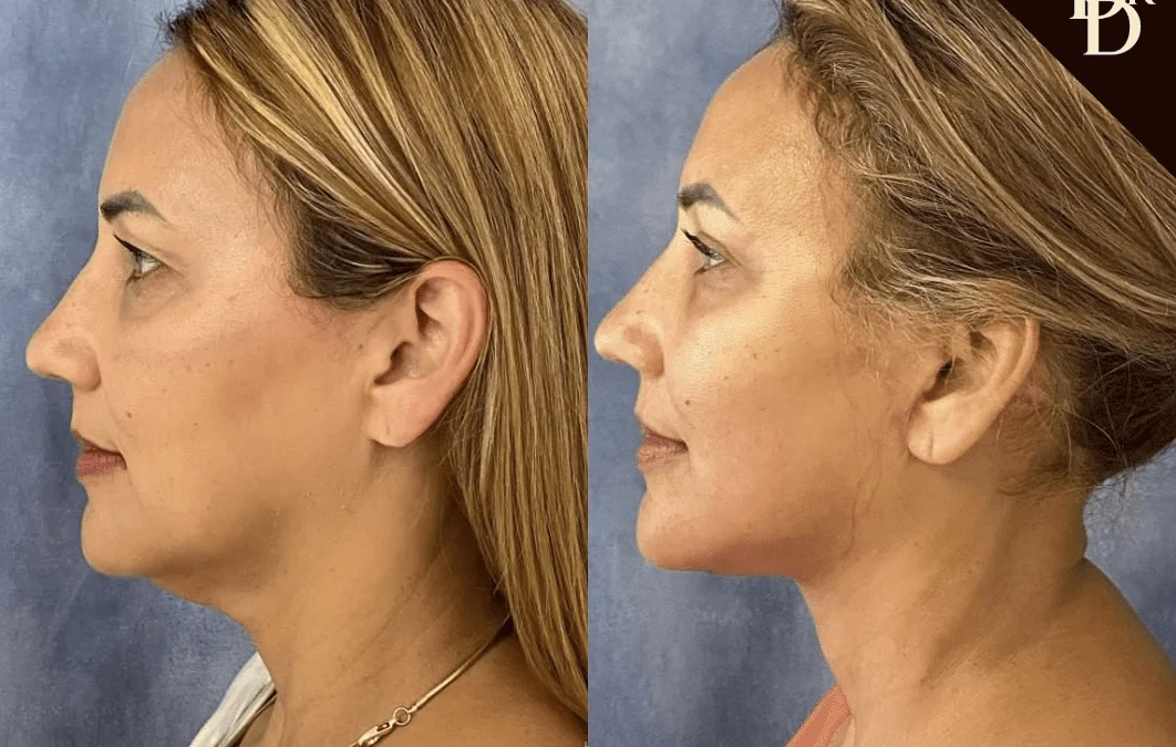 Facelift Before And After Photos By Dr. Demetri Arnaoutakis In Tampa, Fl
