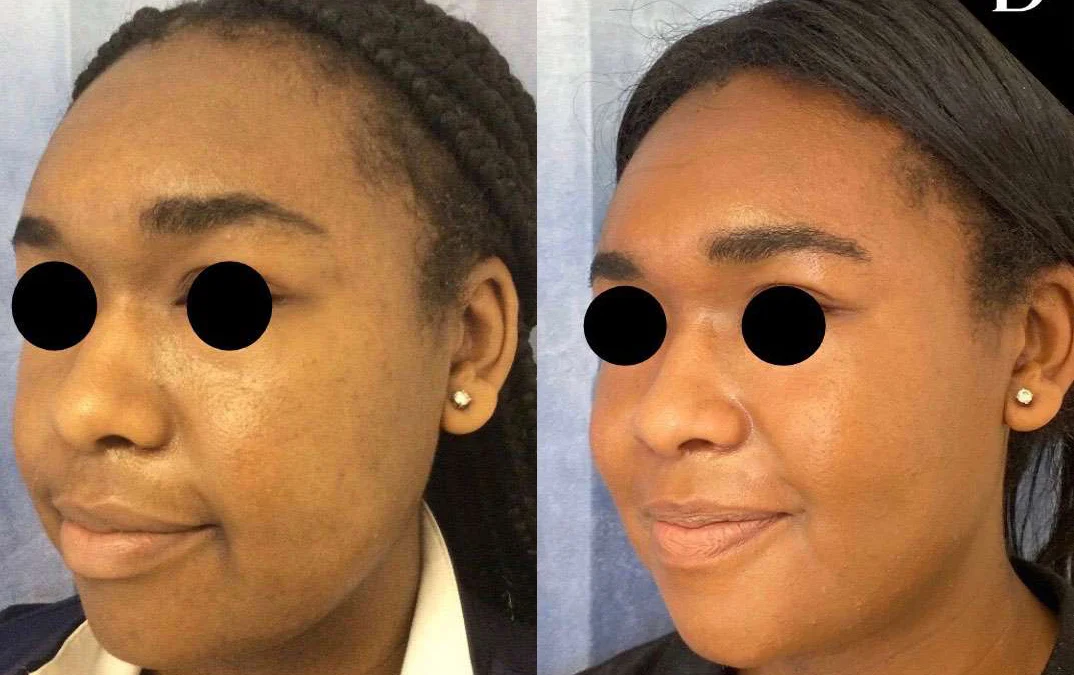 Buccal Fat Pad Removal before and after photos by Dr. Demetri Arnaoutakis in Tampa, FL