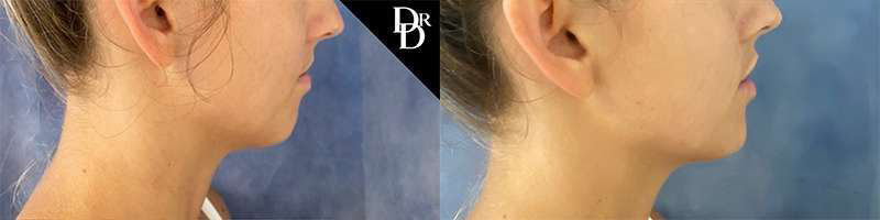 Chin Augmentation Before And After Photos By Dr. Demetri Arnaoutakis In Tampa, Fl