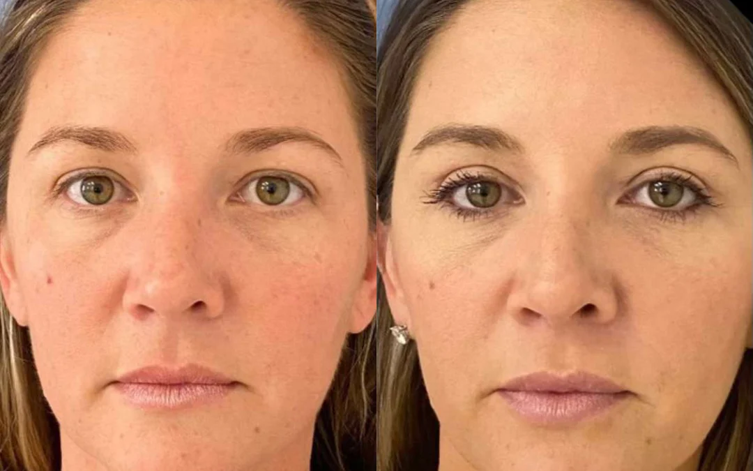 Eyelid Surgery before and after photos by Dr. Demetri Arnaoutakis in Tampa, FL