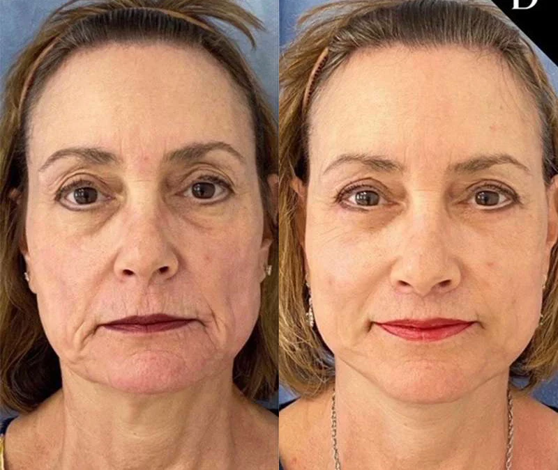 Facelift Before And After Photos By Dr. Demetri Arnaoutakis In Tampa, Fl