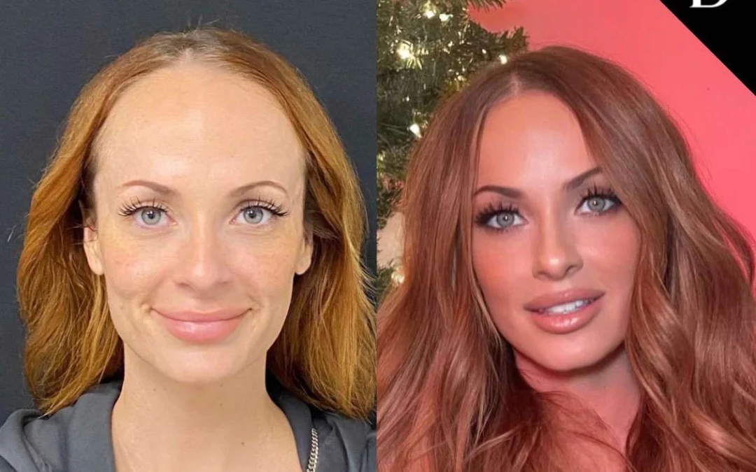 Hairline Lowering Surgery Before And After Photos By Dr. Demetri Arnaoutakis In Tampa, Fl