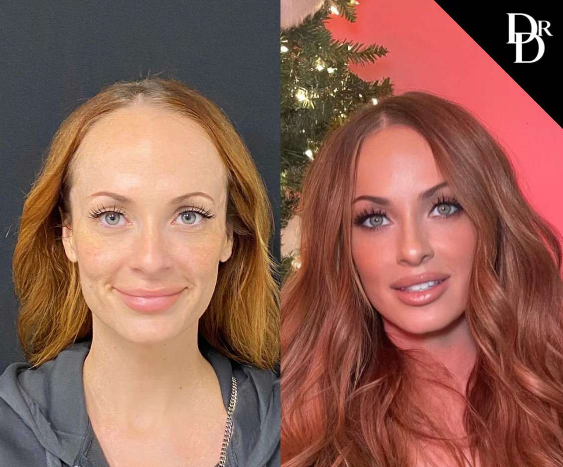 Hairline Lowering Surgery Before And After Photos By Dr. Demetri Arnaoutakis In Tampa, Fl