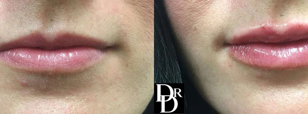 Injectable/Dermal Fillers Before And After Photos By Dr. Demetri Arnaoutakis In Tampa, Fl