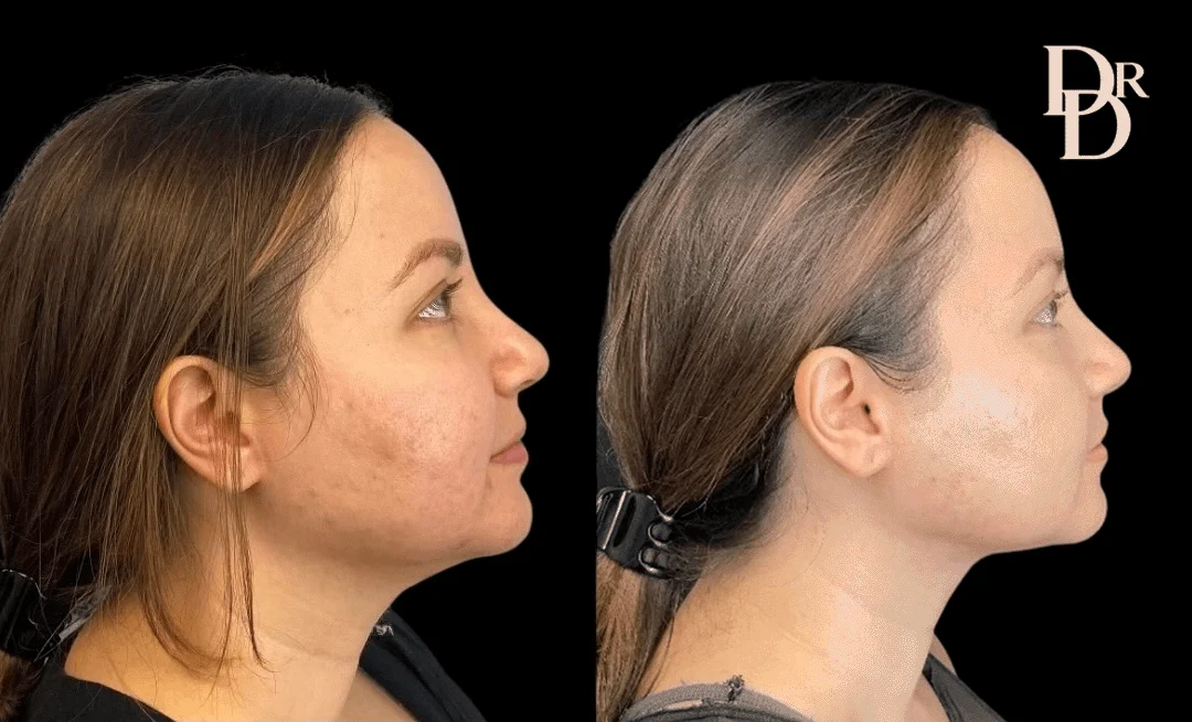 Morpheus8 Before And After Photos By Dr. Demetri Arnaoutakis In Tampa, Fl