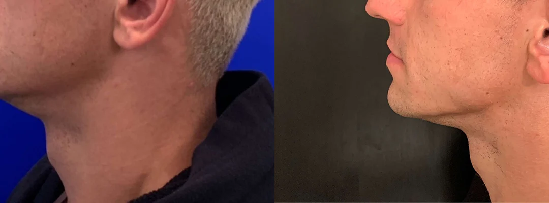 Neck Lift Before And After Photos By Dr. Demetri Arnaoutakis In Tampa, Fl