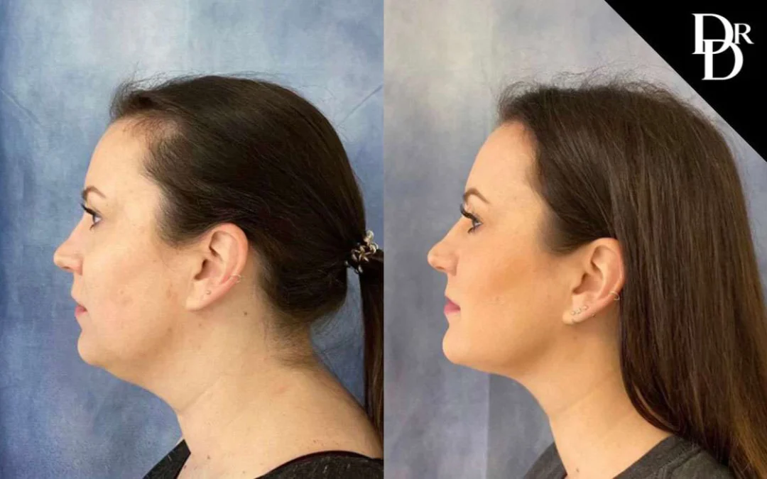 Facetite Before And After Photos By Dr. Demetri Arnaoutakis In Tampa, Fl