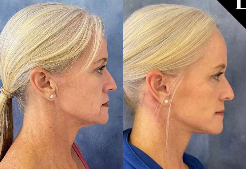 Facelift Before And After Photos By Dr. Demetri Arnaoutakis In Tampa, Fl
