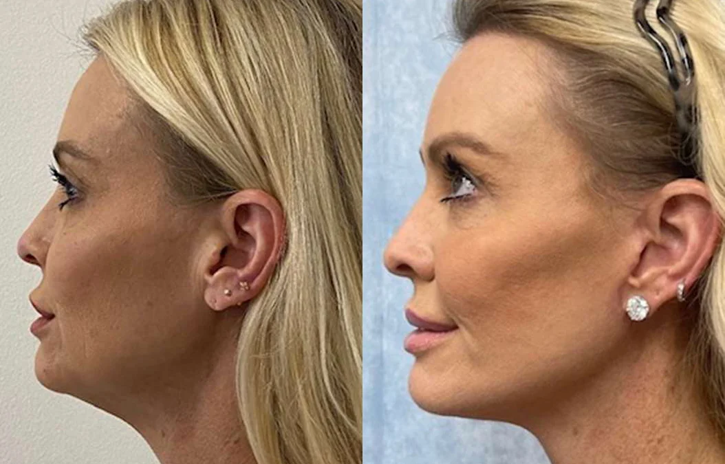 Facelift Before And After Photos By Dr. Demetri Arnaoutakis In Tampa, Fl