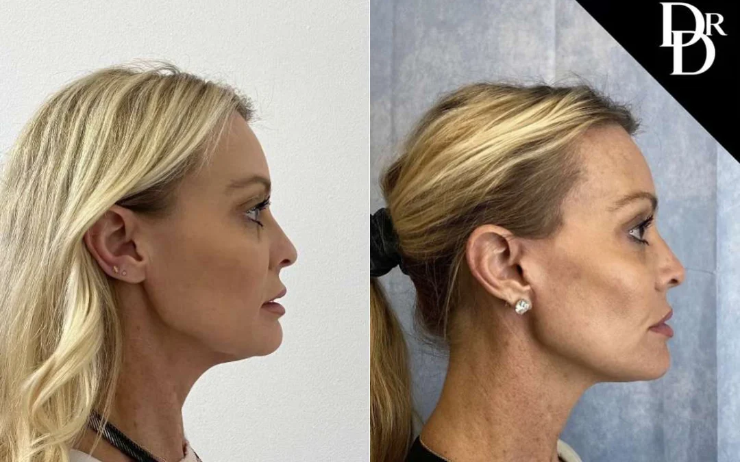 Facelift Before And After Photos By Dr. Demetri Arnaoutakis In Tampa, Fl