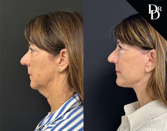 Facelift Before And After Photos By Dr. Demetri Arnaoutakis In Tampa, Fl