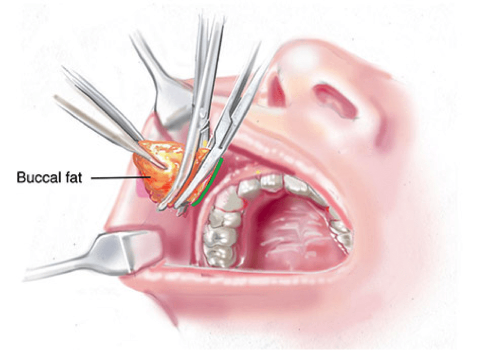 Buccal Fat Pad Removal Buccal Fat Pad Removal